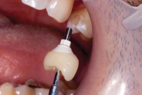 crown on implant