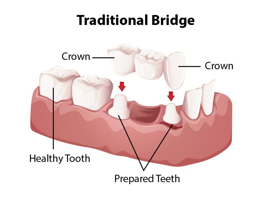 Dental Bridge And The Most 3 Common Types Of Dental Bridge