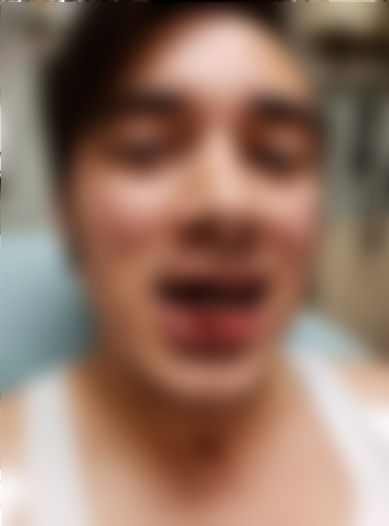 Ibu Ngeri Tengok Rahang Anak Pecah, Gigi Bersepai Gara-Gara ‘Vape’ Meletup Dalam Mulut