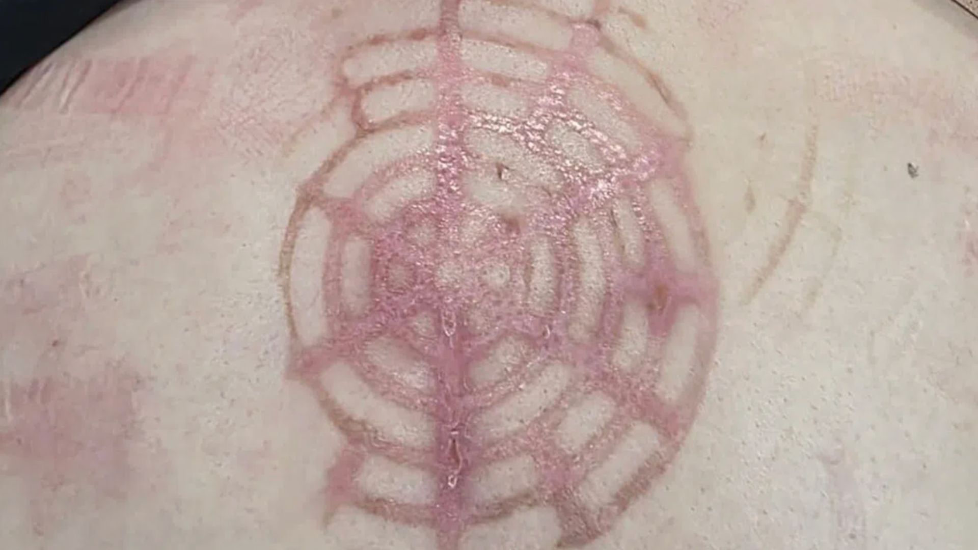 Relaxing massage turns painful after infrared therapy lamp allegedly falls on customer